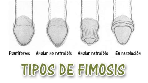 foto fimosis|Imágenes